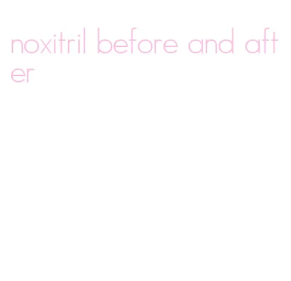 noxitril before and after